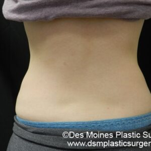 CoolSculpting Before and After Photo by Coachlight Clinic & Spa in West Des Moines Iowa