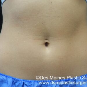 CoolSculpting Before and After Photo by Coachlight Clinic & Spa in West Des Moines Iowa