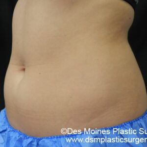 CoolSculpting Before and After Photo by Coachlight Clinic & Spa in West Des Moines Iowa