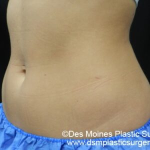 CoolSculpting Before and After Photo by Coachlight Clinic & Spa in West Des Moines Iowa