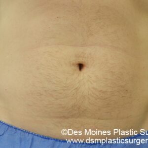 CoolSculpting Before and After Photo by Coachlight Clinic & Spa in West Des Moines Iowa