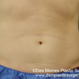 CoolSculpting Before and After Photo by Coachlight Clinic & Spa in West Des Moines Iowa