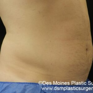 CoolSculpting Before and After Photo by Coachlight Clinic & Spa in West Des Moines Iowa