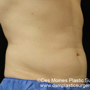 CoolSculpting Before and After Photo by Coachlight Clinic & Spa in West Des Moines Iowa