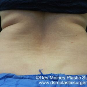 CoolSculpting Before and After Photo by Coachlight Clinic & Spa in West Des Moines Iowa