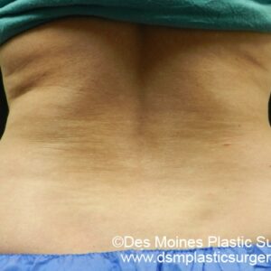 CoolSculpting Before and After Photo by Coachlight Clinic & Spa in West Des Moines Iowa