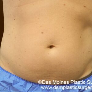 CoolSculpting Before and After Photo by Coachlight Clinic & Spa in West Des Moines Iowa