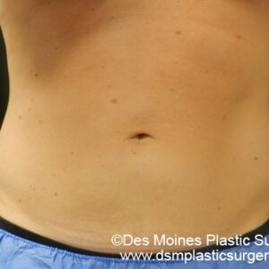 CoolSculpting Before and After Photo by Coachlight Clinic & Spa in West Des Moines Iowa