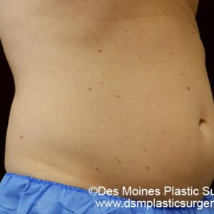 CoolSculpting Before and After Photo by Coachlight Clinic & Spa in West Des Moines Iowa