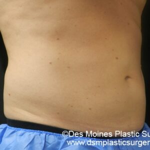 CoolSculpting Before and After Photo by Coachlight Clinic & Spa in West Des Moines Iowa