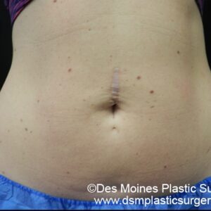 CoolSculpting Before and After Photo by Coachlight Clinic & Spa in West Des Moines Iowa