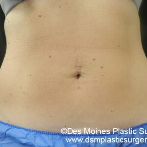 CoolSculpting Before and After Photo by Coachlight Clinic & Spa in West Des Moines Iowa