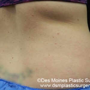 CoolSculpting Before and After Photo by Coachlight Clinic & Spa in West Des Moines Iowa