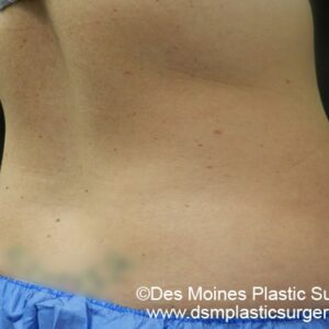 CoolSculpting Before and After Photo by Coachlight Clinic & Spa in West Des Moines Iowa