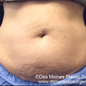 CoolSculpting Before and After Photo by Coachlight Clinic & Spa in West Des Moines Iowa