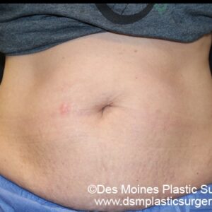 CoolSculpting Before and After Photo by Coachlight Clinic & Spa in West Des Moines Iowa