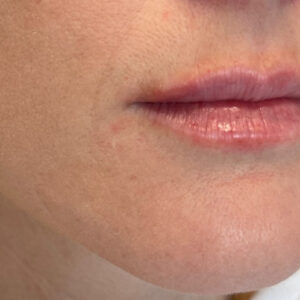 Lip Filler Before and After Photo by Coachlight Clinic & Spa in West Des Moines Iowa