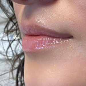 Lip Filler before photo by Coachlight Clinic and Spa in Des Moines Iowa