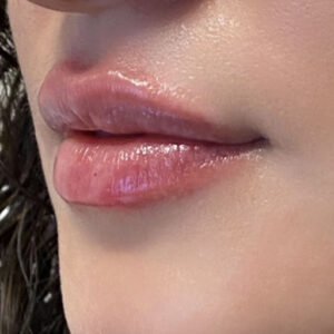 Lip Filler after photo by Coachlight Clinic and Spa in Des Moines Iowa