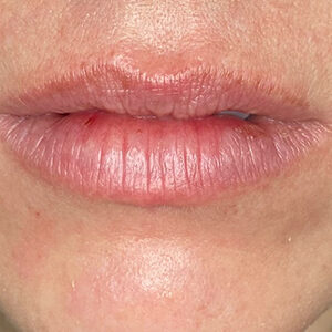 Lip Filler Before and After Photo by Coachlight Clinic & Spa in West Des Moines Iowa