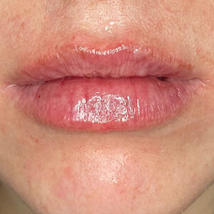 Lip Filler Before and After Photo by Coachlight Clinic & Spa in West Des Moines Iowa