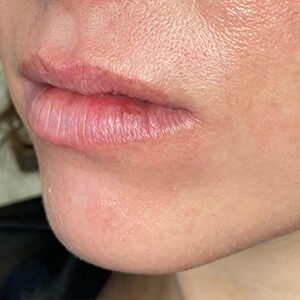 Lip Filler Before and After Photo by Coachlight Clinic & Spa in West Des Moines Iowa