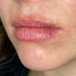 Lip Filler Before and After Photo by Coachlight Clinic & Spa in West Des Moines Iowa