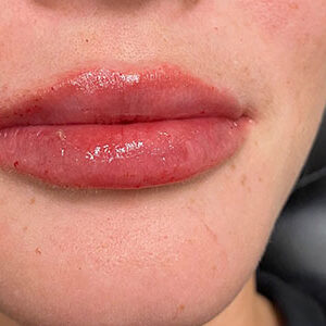 Lip Filler Before and After Photo by Coachlight Clinic & Spa in West Des Moines Iowa