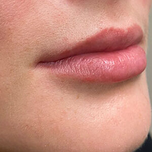 Lip Filler Before and After Photo by Coachlight Clinic & Spa in West Des Moines Iowa