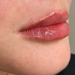 Lip Filler Before and After Photo by Coachlight Clinic & Spa in West Des Moines Iowa