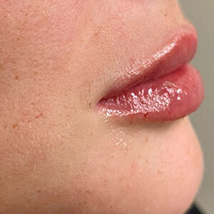 Lip Filler Before and After Photo by Coachlight Clinic & Spa in West Des Moines Iowa