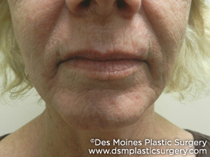Laser Resurfacing Before and After Photo by Coachlight Clinic & Spa in West Des Moines Iowa