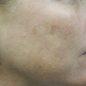 BBL® & BBL® HERO™ Before and After Photo by Coachlight Clinic & Spa in West Des Moines Iowa