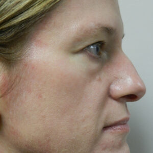 BBL® & BBL® HERO™ Before and After Photo by Coachlight Clinic & Spa in West Des Moines Iowa