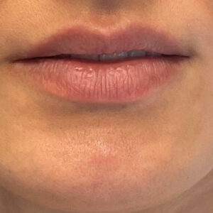 Lip Filler Before and After Photo by Coachlight Clinic & Spa in West Des Moines Iowa