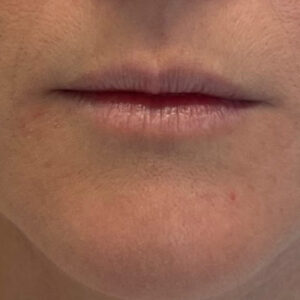 Lip Filler Before and After Photo by Coachlight Clinic & Spa in West Des Moines Iowa