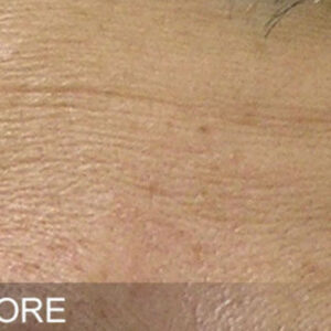 HydraFacial Before and After Photo by Coachlight Clinic & Spa in West Des Moines Iowa