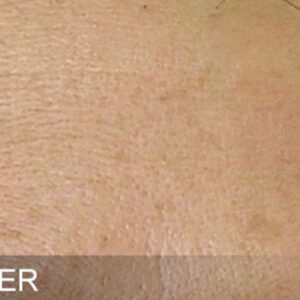 HydraFacial Before and After Photo by Coachlight Clinic & Spa in West Des Moines Iowa