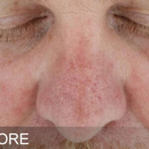 HydraFacial Before and After Photo by Coachlight Clinic & Spa in West Des Moines Iowa