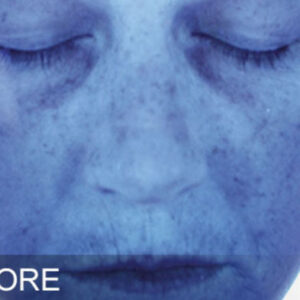 HydraFacial Before and After Photo by Coachlight Clinic & Spa in West Des Moines Iowa