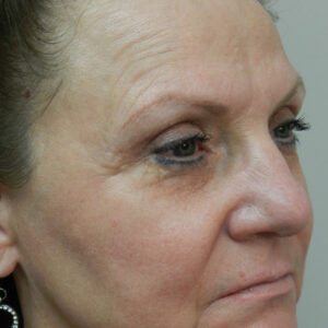 HALO Before and After Photo by Coachlight Clinic & Spa in West Des Moines Iowa