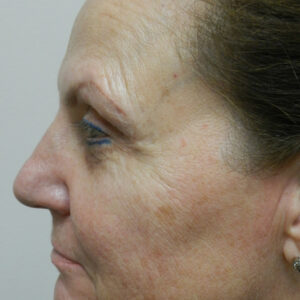 HALO Before and After Photo by Coachlight Clinic & Spa in West Des Moines Iowa