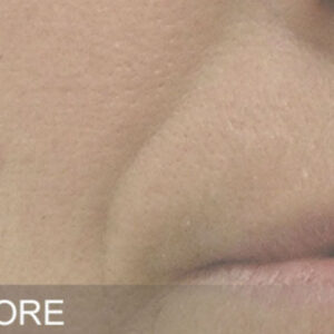 HydraFacial Before and After Photo by Coachlight Clinic & Spa in West Des Moines Iowa