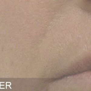 HydraFacial Before and After Photo by Coachlight Clinic & Spa in West Des Moines Iowa