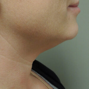 Kybella Before and After Photo by Coachlight Clinic & Spa in West Des Moines Iowa