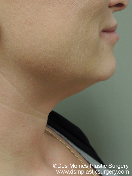 Kybella Before and After Photo by Coachlight Clinic & Spa in West Des Moines Iowa