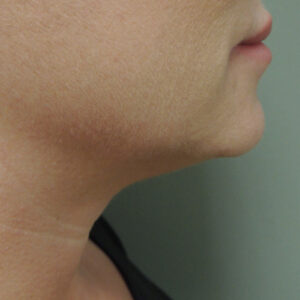 Kybella Before and After Photo by Coachlight Clinic & Spa in West Des Moines Iowa