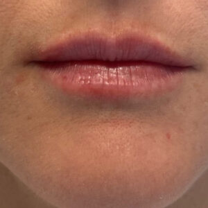 Lip Filler Before and After Photo by Coachlight Clinic & Spa in West Des Moines Iowa