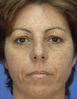 Laser Resurfacing Before and After Photo by Coachlight Clinic & Spa in West Des Moines Iowa