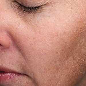 MOXI Before and After Photo by Coachlight Clinic & Spa in West Des Moines Iowa
